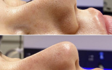 reskinpro oczyszczanie wodorowe